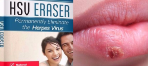 Herpes Erased Review