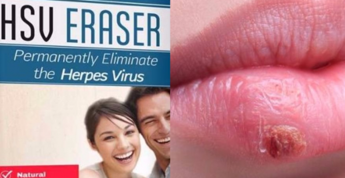 Herpes Erased Review